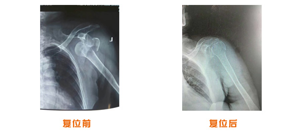 復(fù)位前后對比